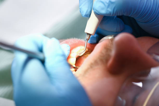 Best Knocked-Out Tooth (Avulsed Tooth) Treatment in Cimarron Hills, CO